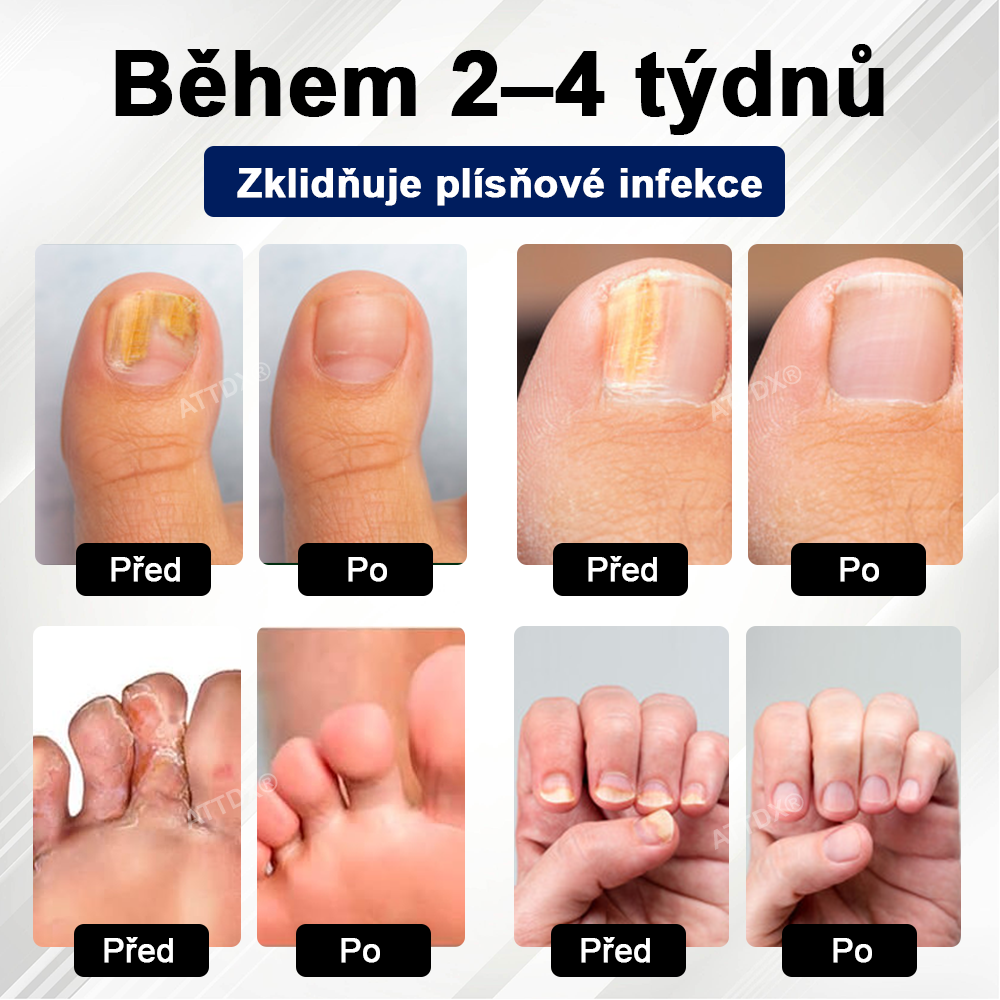 ATTDX® Fungiclear Sprej na nehty s včelí terapií