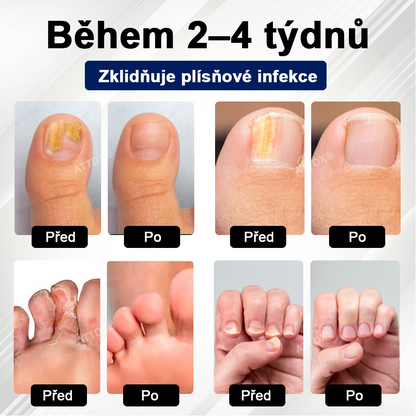 ATTDX® Fungiclear Sprej na nehty s včelí terapií