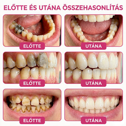 🥇CleraNaure® DenPerm Üregjavító Természetes Zománctömő Gél
