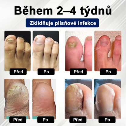ATTDX® Fungiclear Sprej na nehty s včelí terapií