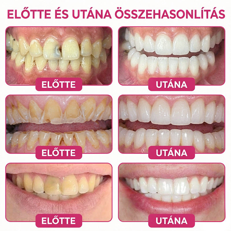 🥇CleraNaure® DenPerm Üregjavító Természetes Zománctömő Gél