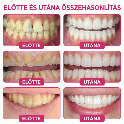 🥇CleraNaure® DenPerm Üregjavító Természetes Zománctömő Gél