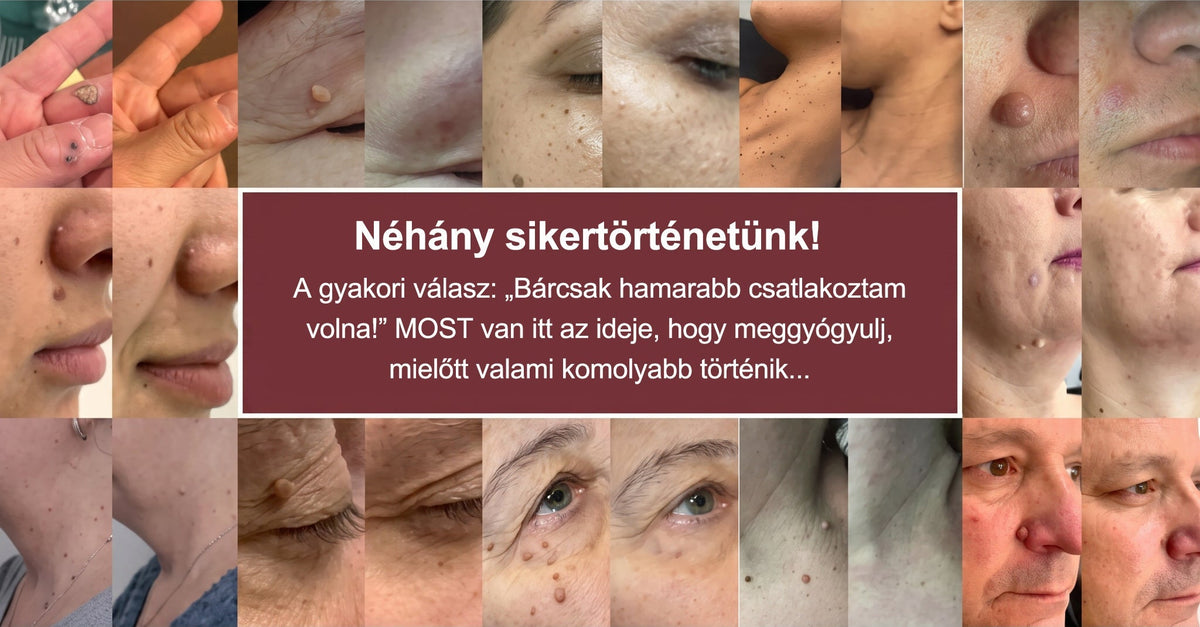 CleraNaure® 2 az 1-ben mikrotűs és hidrokolloid tapasz | Kiálló anyajegyek, aknék, lapos szemölcsök és bőrnövedékek eltávolítására | Segít csökkenteni a ráncokat, hegeket és bőrhibákat | Láthatatlan tapasz az arcra és testre