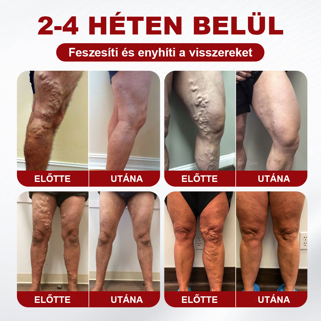 CleraNaure® visszérkezelő krém
