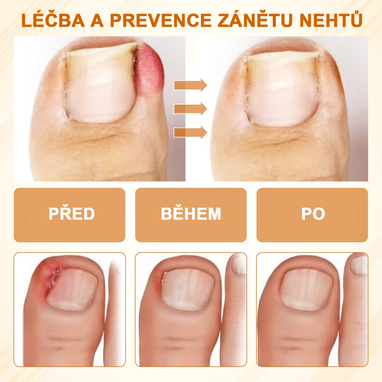 ATTDX® Fungiclear Sprej na nehty s včelí terapií