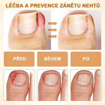 ATTDX® Fungiclear Sprej na nehty s včelí terapií