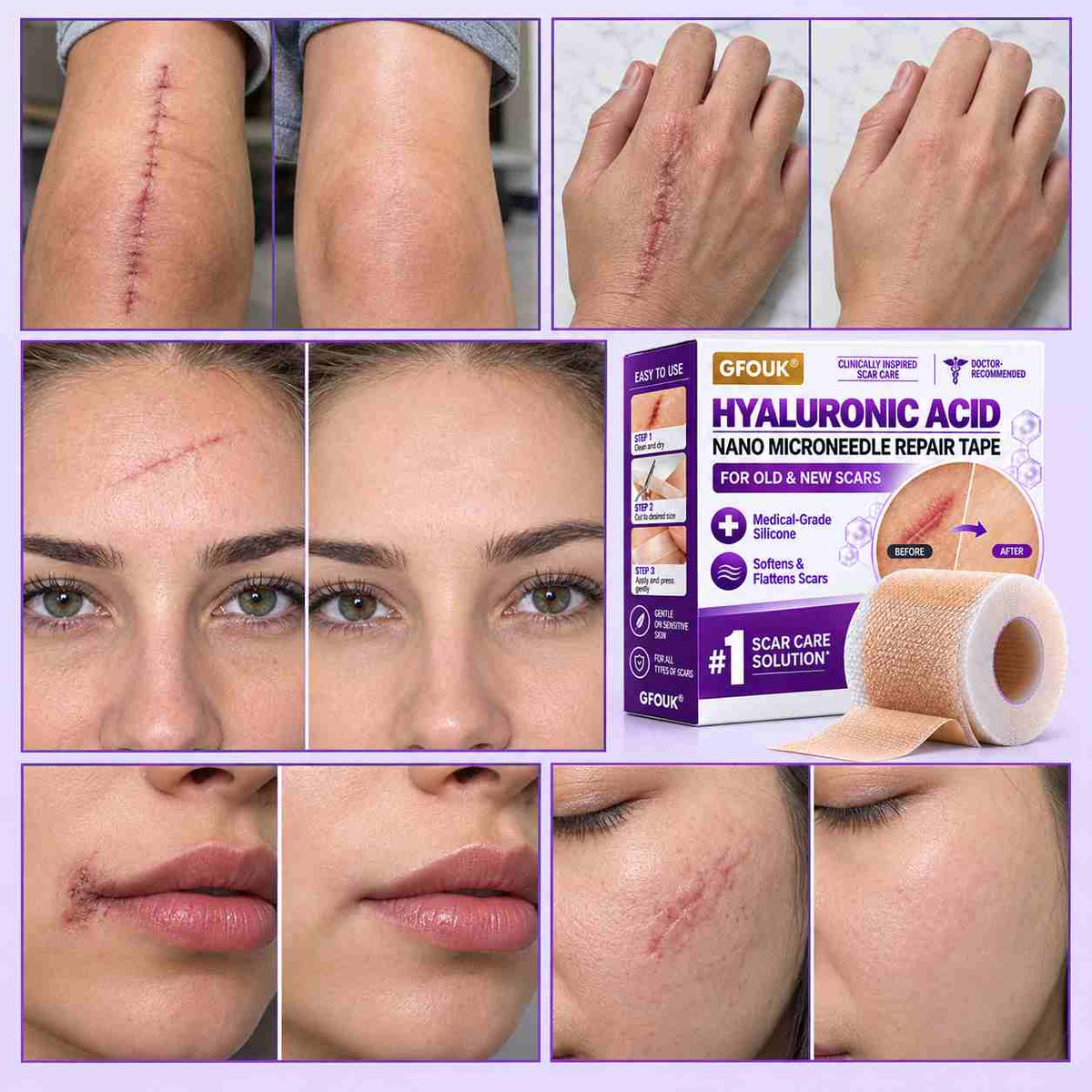 ✅GFOUK® Hyaluronic Acid Nano Microneedle Repair Tape🗽🎁