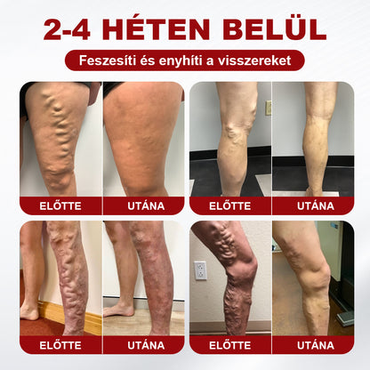 CleraNaure® visszérkezelő krém