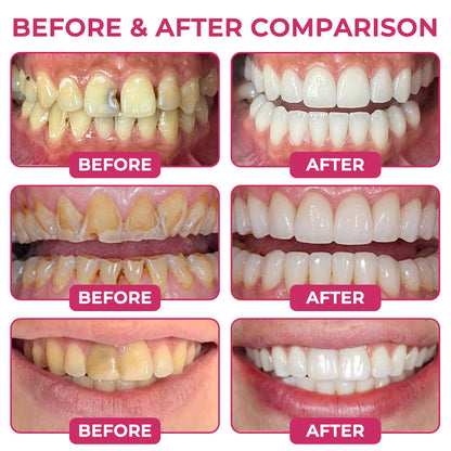 Rolimey® DenPerm Cavity-Repair Natural Enamel Filling Gel