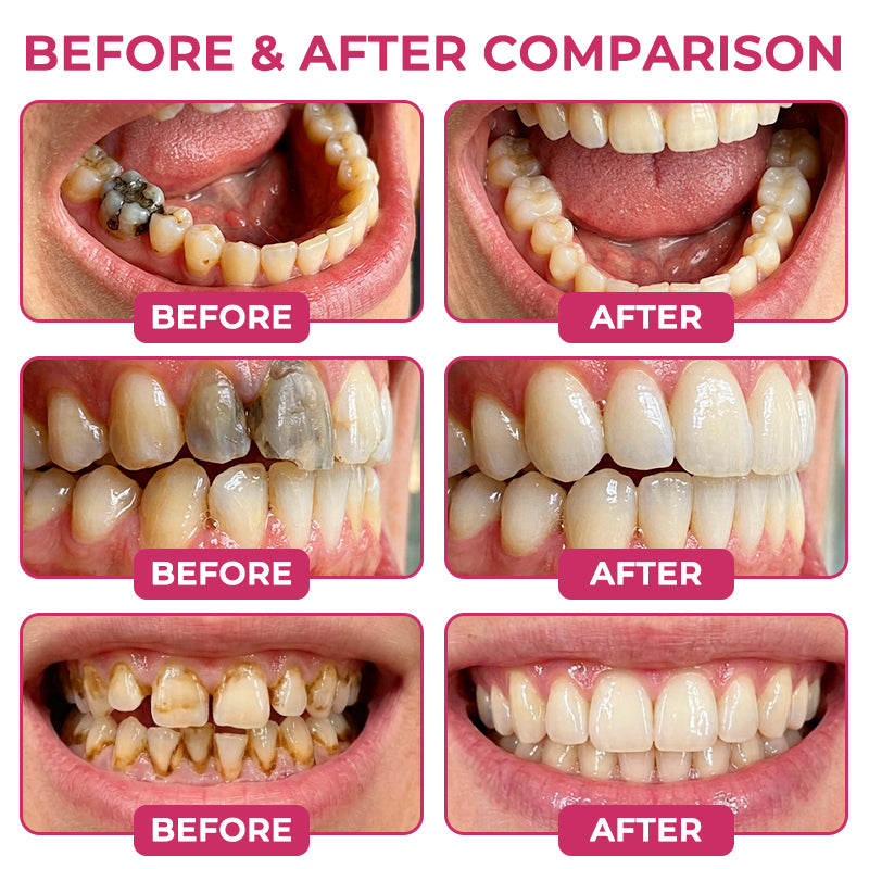 Rolimey® DenPerm Cavity-Repair Natural Enamel Filling Gel